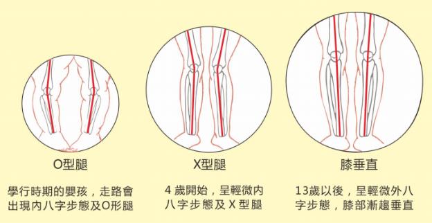 想要孩子擁有筆直長(zhǎng)腿,家長(zhǎng)應(yīng)及時(shí)給孩子定制矯正鞋干預(yù)