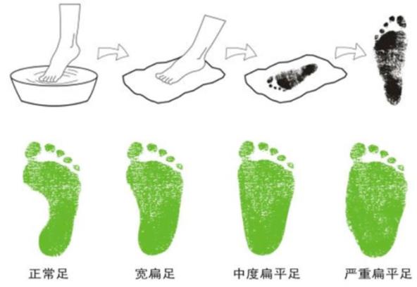 孩子走路腳疼可能是扁平足 矯正鞋干預(yù)要趁早