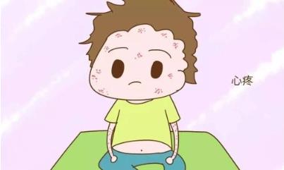 嬰兒濕疹怎么好得快,媽媽們點進來