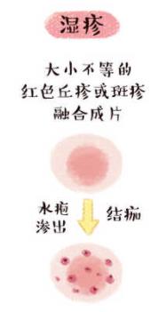 寶寶起濕疹了怎么辦,超啟能恩來幫忙