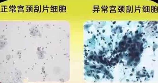 宮頸刮片檢查什么 宮頸刮片正常值
