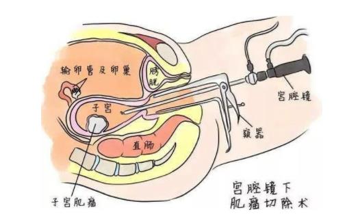 宮腔鏡檢查大概多少錢 宮腔鏡檢查的4大注意事項(xiàng)