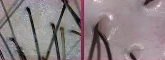 你知道頭皮的真實狀況嗎?青逸植發(fā)告訴你:發(fā)質(zhì)不好是因為