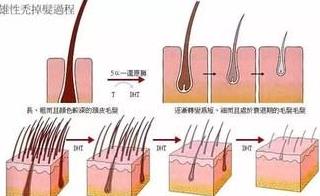 頭發(fā)越來越細(xì),越稀怎么辦?脂溢性脫發(fā),雄性脫發(fā),護發(fā)仁