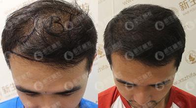 合肥新生植發(fā)科普,植發(fā)受季節(jié)的影響嗎?哪個(gè)季節(jié)植發(fā)最好?