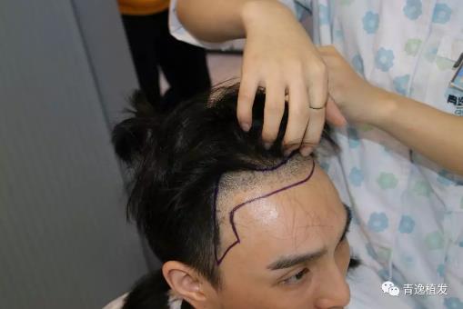 實(shí)力青逸,技術(shù)“植”播于2019年3月10號(hào)在深圳青逸植發(fā)醫(yī)院舉行