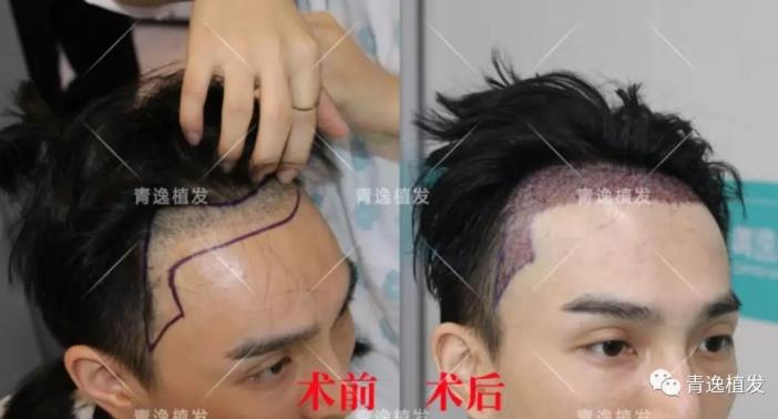 實(shí)力青逸,技術(shù)“植”播于2019年3月10號(hào)在深圳青逸植發(fā)醫(yī)院舉行