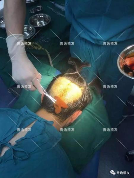 實(shí)力青逸,技術(shù)“植”播于2019年3月10號(hào)在深圳青逸植發(fā)醫(yī)院舉行