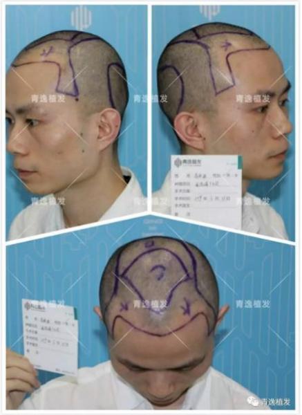 在深圳青逸植發(fā)醫(yī)院舉辦的實力青逸,技術(shù)“植”播圓滿成功