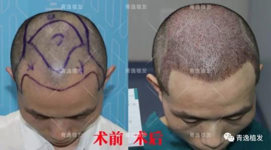 在深圳青逸植發(fā)醫(yī)院舉辦的實力青逸,技術(shù)“植”播圓滿成功