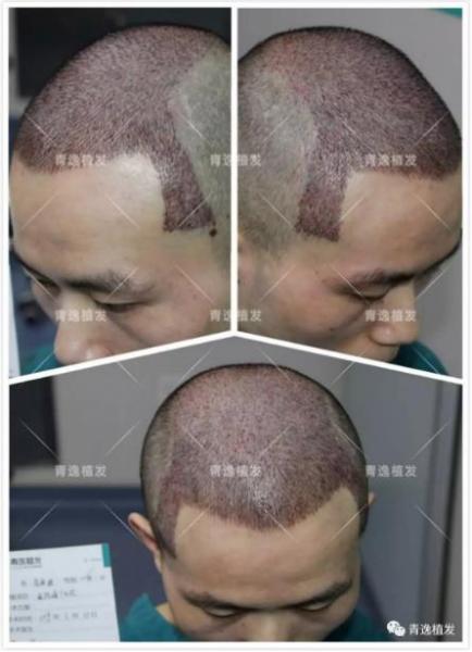 在深圳青逸植發(fā)醫(yī)院舉辦的實力青逸,技術(shù)“植”播圓滿成功