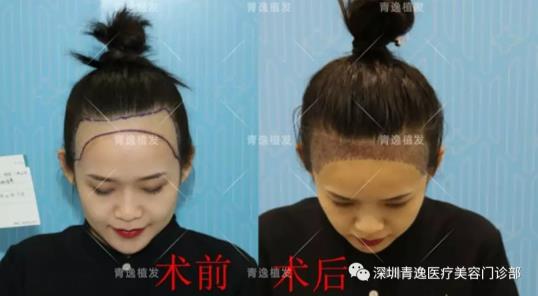 青逸植發(fā)醫(yī)院眾多醫(yī)生跟專家一同見(jiàn)證青逸咨詢助理唯唯的完美蛻變