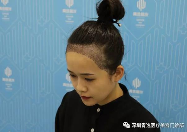 青逸植發(fā)醫(yī)院眾多醫(yī)生跟專家一同見(jiàn)證青逸咨詢助理唯唯的完美蛻變