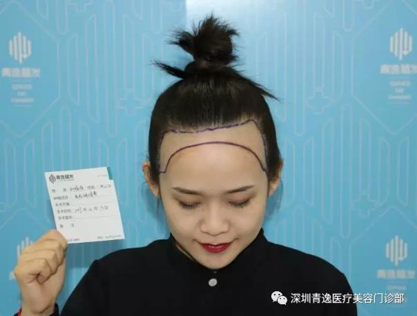 帶您觀看青逸植發(fā)醫(yī)院發(fā)際線種植術(shù)后五天效果是什么樣