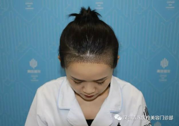 帶您觀看青逸植發(fā)醫(yī)院發(fā)際線種植術(shù)后五天效果是什么樣