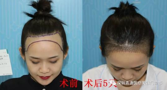 帶您觀看青逸植發(fā)醫(yī)院發(fā)際線種植術(shù)后五天效果是什么樣