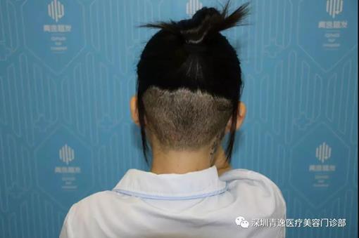 大腦門寬額頭還有救嗎?青逸植發(fā)醫(yī)院發(fā)際線種植了解一下?