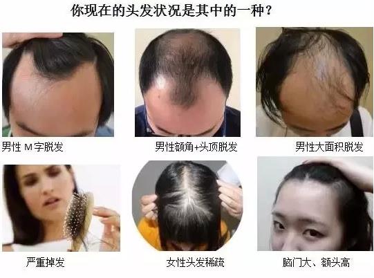 What?脫發(fā)更長(zhǎng)壽?一招讓你既長(zhǎng)壽又有顏!