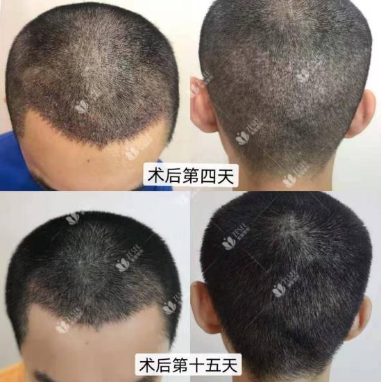 What?脫發(fā)更長(zhǎng)壽?一招讓你既長(zhǎng)壽又有顏!