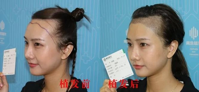 當(dāng)紅模特到青逸植發(fā)醫(yī)院做發(fā)際線移植手術(shù)畫面曝光