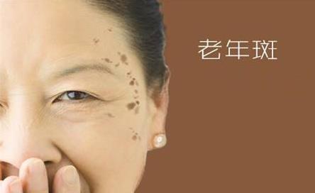 老年斑是怎樣產(chǎn)生的呢 男性如何去除老年斑