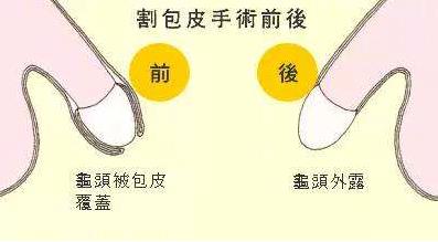 男人為什么要割包皮?割包皮前要注意事項(xiàng) 割包皮后注意事項(xiàng)