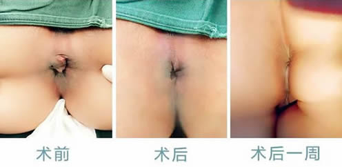 女性痔瘡真人實(shí)拍圖片 網(wǎng)上曝光的7個(gè)小偏方有效治痔瘡 女性痔瘡真人實(shí)拍圖片:網(wǎng)上曝光的7個(gè)小偏方有效治痔瘡