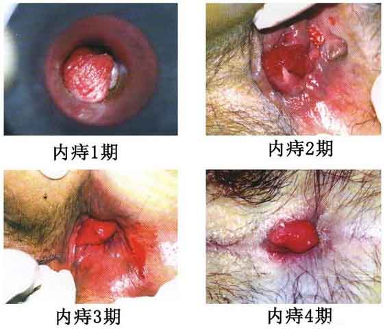 女性痔瘡真人實(shí)拍圖片 網(wǎng)上曝光的7個(gè)小偏方有效治痔瘡 女性痔瘡真人實(shí)拍圖片:網(wǎng)上曝光的7個(gè)小偏方有效治痔瘡