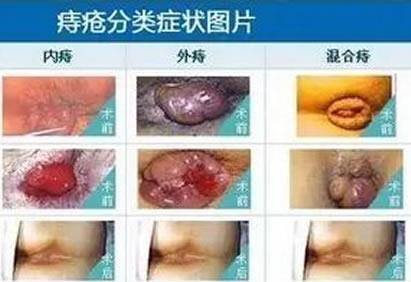 女性痔瘡真人實(shí)拍圖片 網(wǎng)上曝光的7個(gè)小偏方有效治痔瘡