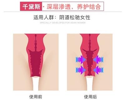 千黛斯怎么樣有沒(méi)有效果?牢記3點(diǎn)信心十足!