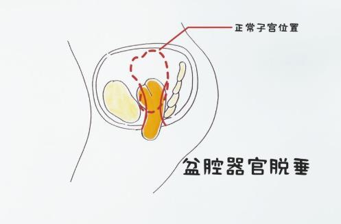 得了盆腔臟器脫垂怎么辦?盆腔臟器脫垂患者如何護(hù)理