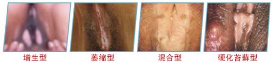 南京瑪麗婦科醫(yī)生高珈瓊:外陰白斑易變 一刻都不容耽擱