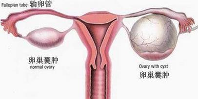 北京建國醫(yī)院評價高嗎 “卵巢囊腫可能導(dǎo)致女性不孕”