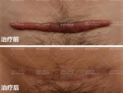 重慶瑪恩皮膚醫(yī)院治剖腹產(chǎn)疤痕好嗎?多重方式供您選擇