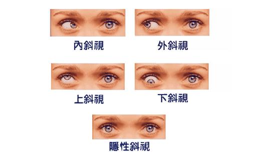 兒童斜視是什么 如何預(yù)防兒童斜視