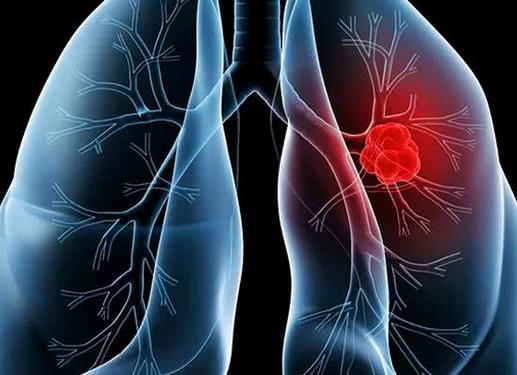 世界十大痛苦癌癥排行,胃癌發(fā)病率高,肺癌死亡率最快