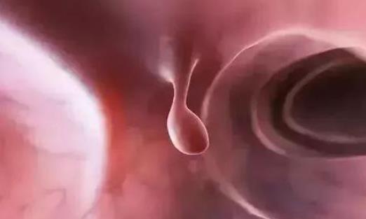 大腸息肉會(huì)自行消失嗎?引起大腸息肉的原因有哪些?