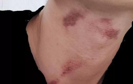 剛種的吻痕熱敷還是冷敷 吻痕要怎么去除