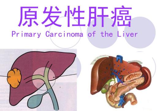 原發(fā)性肝癌不能吃什么?原發(fā)性肝癌的早期癥狀