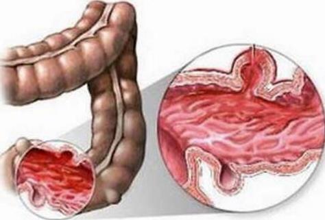 放射性腸炎的飲食禁忌是什么?放射性腸炎的危害