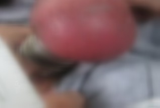 (男子嘿咻九鋼環(huán)套蛋 睪丸腫如橘子險絕后.jpg