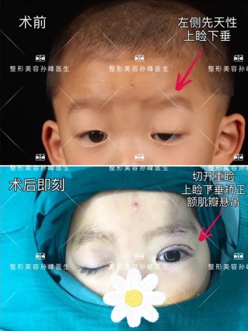 西安國際醫(yī)學(xué)孫峰醫(yī)生《女友雜志》專訪,帶你揭秘眼睛變漂亮的秘密