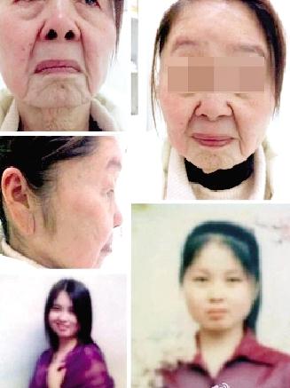 85年少婦分娩后變老太，獲得性面部皮膚衰老癥怪病無(wú)藥可醫(yī)，早婚早育生第二胎