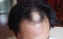 頭頂現(xiàn)“地中?！蔽C(jī) 如何預(yù)防頭頂脫發(fā)