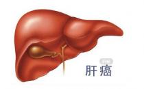  如何預(yù)防肝癌 ？