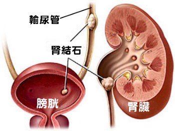 腎結(jié)石