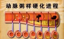 什么是“動粥”？哪些是“動粥疾病”高危人群？