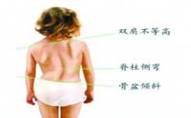 如何盡早發(fā)現(xiàn)孩子脊柱側(cè)彎？