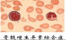 什么是骨髓增生異常綜合征？