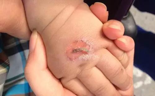 孩子常見的意外損傷類型有哪些？
